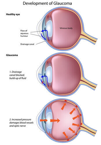 Glaucom Progression Diagram